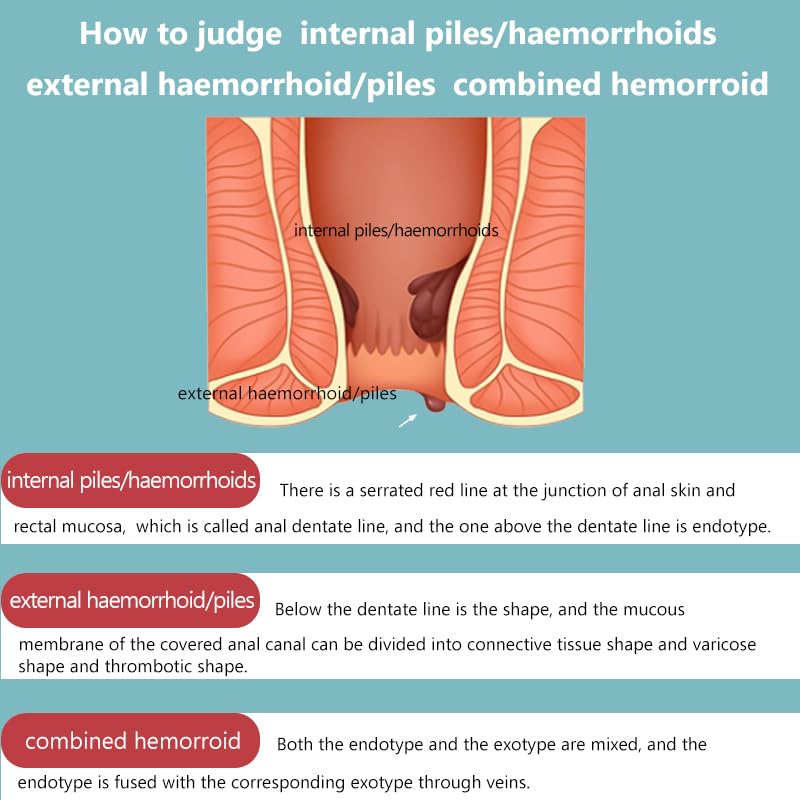 Hemorrhoid Cream for Men and Women, with Lidocaine and Phenylephrine HCl, Provides Fast Relief from hemorrhoid discomfort. Naturally formulated for Hemorrhoids and fissures (0.7 oz) AnisxBuy Supplements Australia