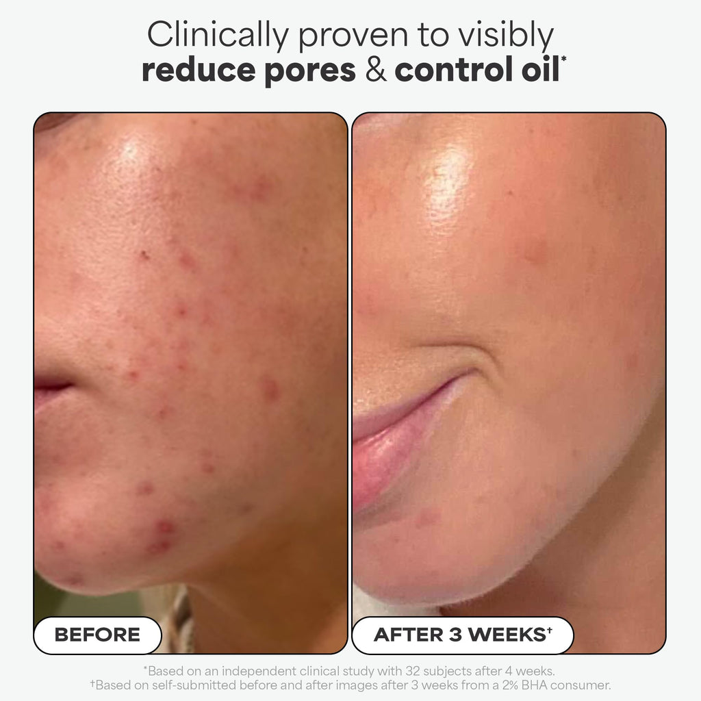 Paulas Choice--SKIN PERFECTING 2% BHA Liquid Salicylic Acid Exfoliant--Facial Exfoliant for Blackheads, Enlarged Pores, Wrinkles & Fine Lines, 4 oz Bottle Paula's ChoiceBuy Supplements Australia