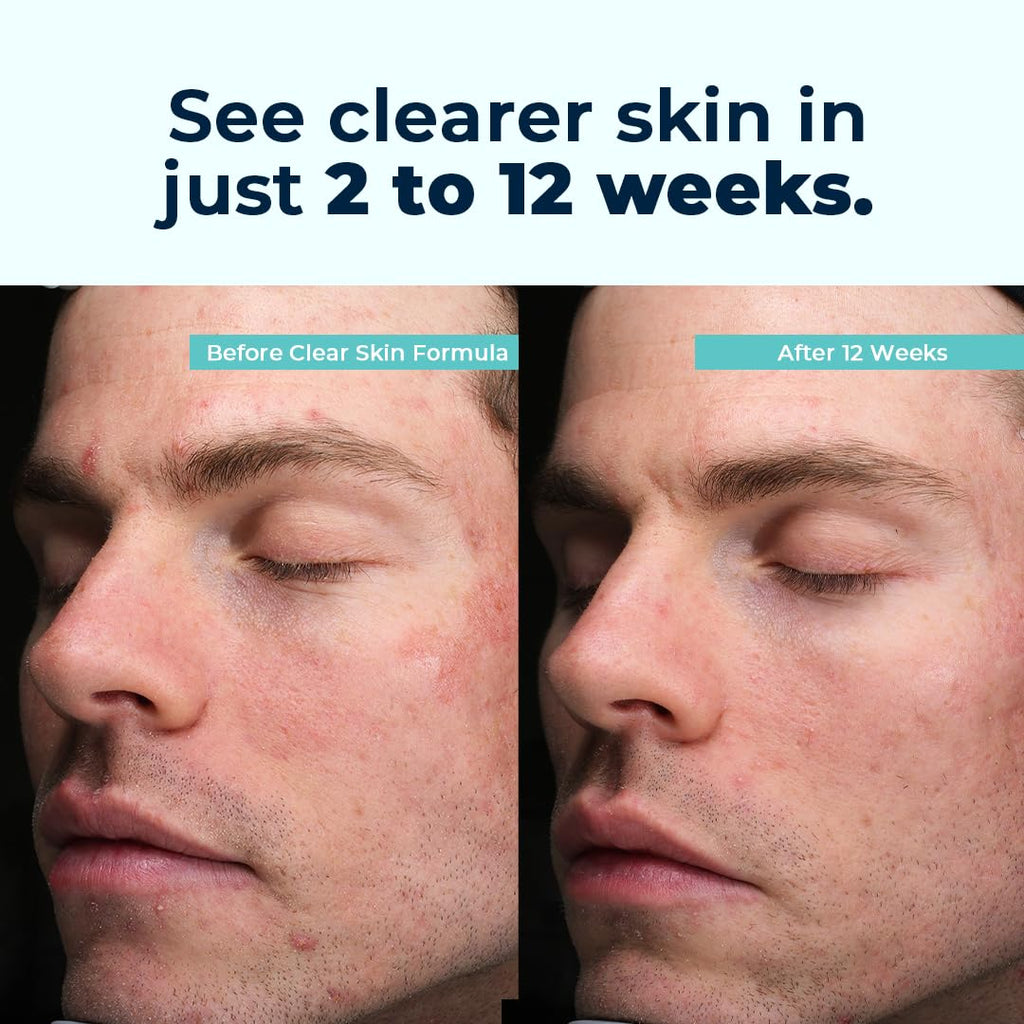 VitaMedica Clear Skin Vitamin Formula | Noncystic Acne Supplement for Skin Clearing | Breakout Treatment for Women and Men | Vitamins A, C, E, Selenium, Chromium, and Zinc for Skin Health | 2 Pack VitaMedicaBuy Supplements Australia