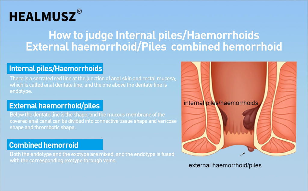 HEALMUSZ Hemorrhoid Fissure Ointment– Hemorrhoid Treatment and Hemorrhoid Cream with Lidocaine and Phenylephrine HCI for Fast Acting Relief of Pain, Swelling, Discomfort, and Itching(1.5 oz) HEALMUSZBuy Supplements Australia
