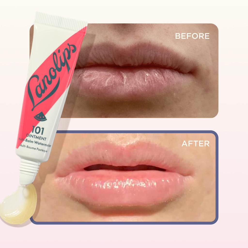Lanolin 101 Multipurpose Ointment - Lanolin Lip Balm & Healing Ointment for Skin Barrier Repair - Moisturizer for Dry Lips, Cuticles & Elbows - No Petroleum Formula - Watermelon (0.35 oz) LanolipsBuy Supplements Australia
