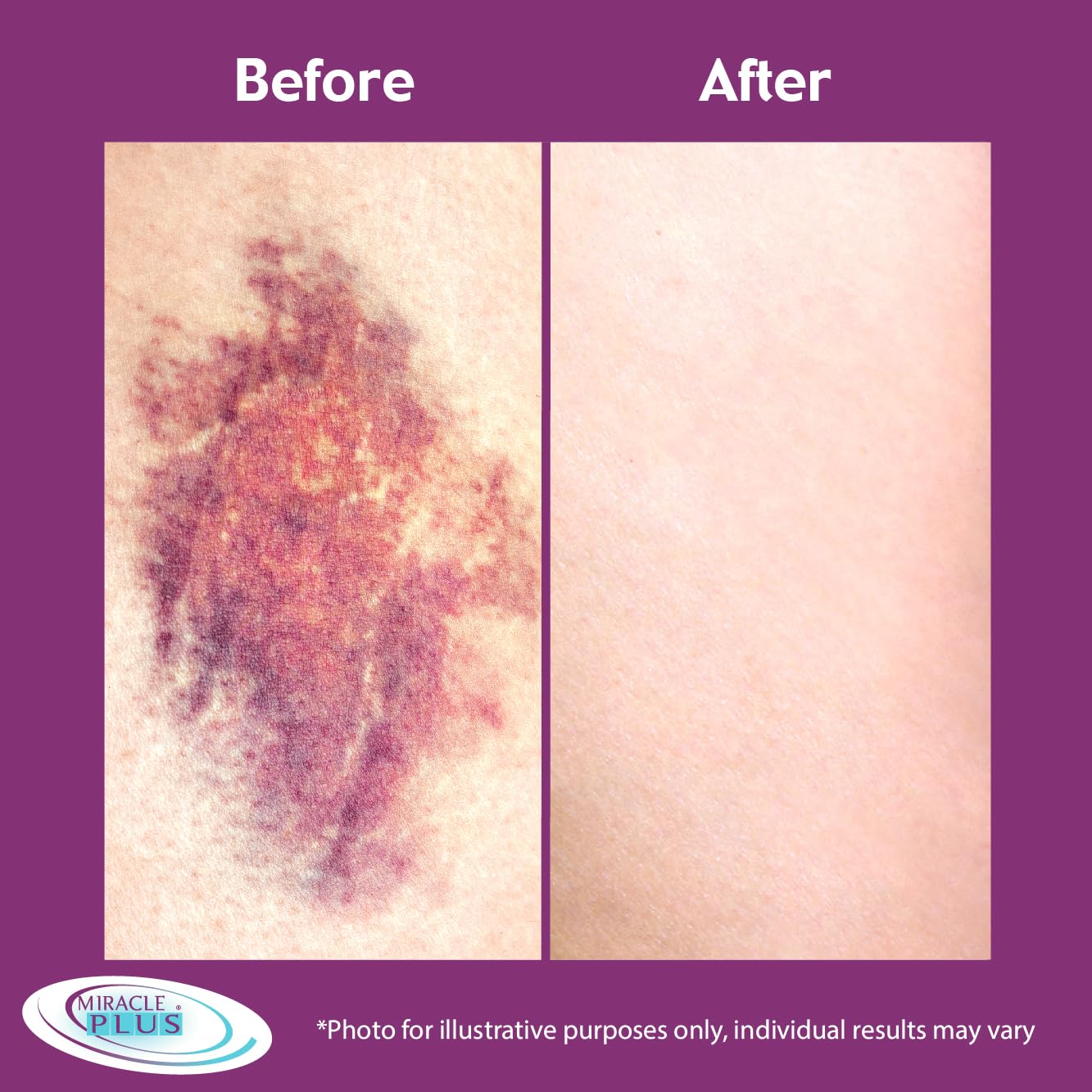 Miracle Plus Arnica Cream Extra Strength Bruise Relief Lotion For Bruising And Swelling On Skin | Arnica Gel, Vitamin K Cream, Skin Care | Moisturizing Bruise Formula With Horse Chestnut, 2-Pack Miracle PlusBuy Supplements Australia
