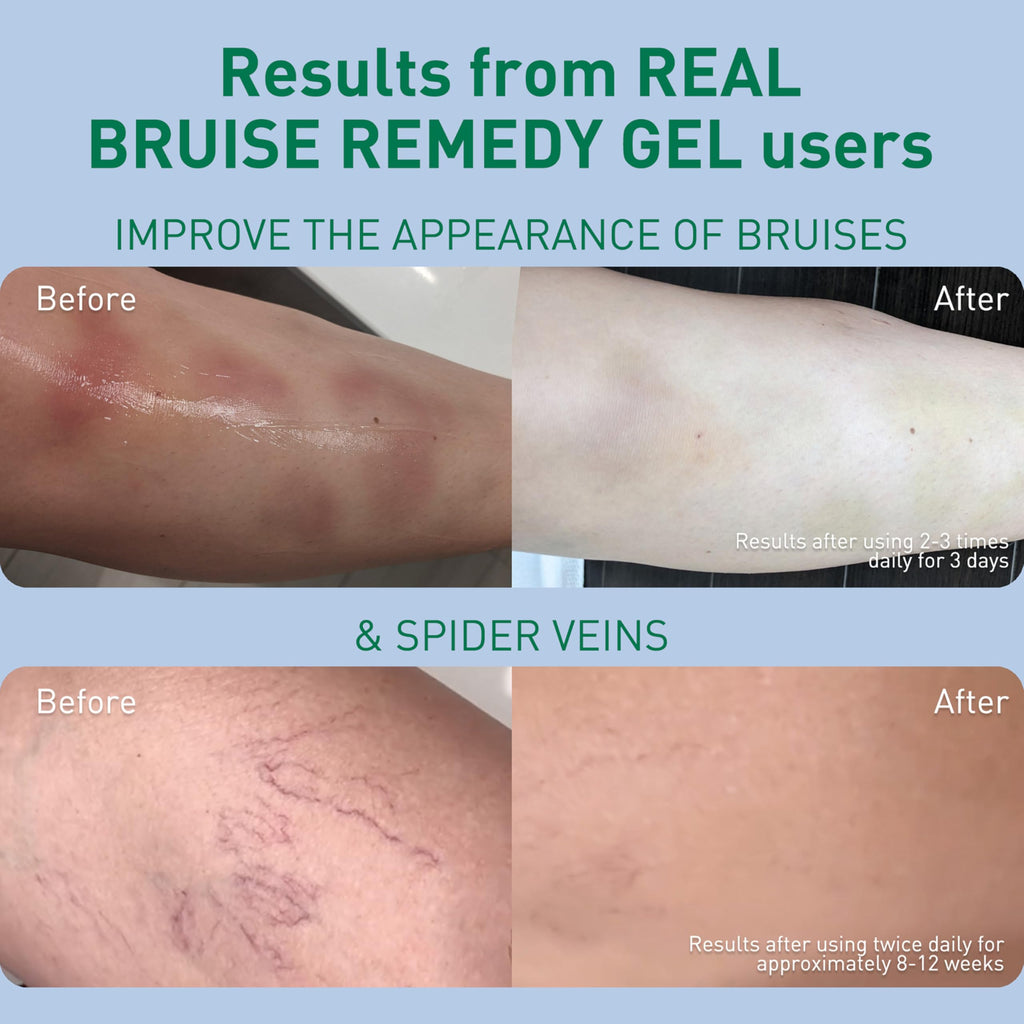 PROcure Arnica & MSM Bruise Remedy Gel – Paraben-Free, Unscented Arnica Montana Gel for Bruising, Spider Veins & Skin Discoloration – 2 Pack PROcureBuy Supplements Australia