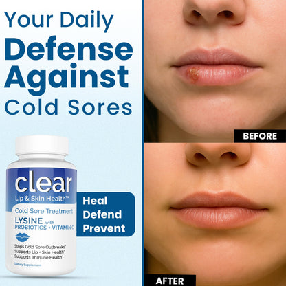 Lysine Cold Sore Treatment for Lips with Pre-Probiotics & VIT C | 1 Month Supply | Supercharged Lysine Capsules with Rhamnosus & Acidophilus for Cold Sores Relief