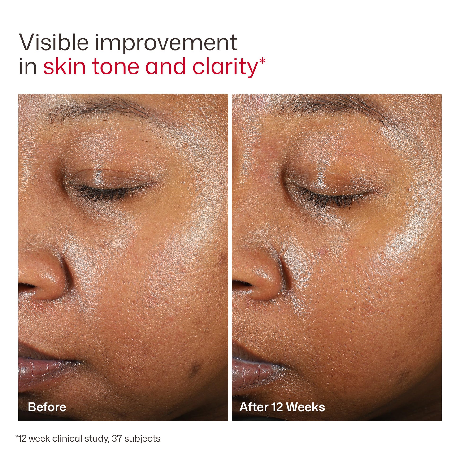 EltaMD UV Clear Tinted Sunscreen for Face, SPF 46 with Zinc Oxide, Oil-Free, Dermatologist Recommended, For Acne-Prone Sensitive Skin, 1.7 oz EltaMDBuy Supplements Australia